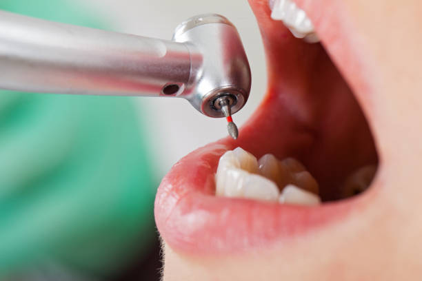 Best Broken or Cracked Tooth Emergency Dentist in Milledgeville, GA
